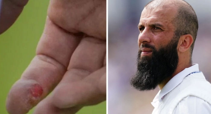 নারী ভক্তের দেওয়া ওষুধে আঙুলের ক্ষত সারল মঈনের